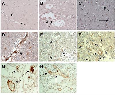 Monomeric C-Reactive Protein: Current Perspectives for Utilization and Inclusion as a Prognostic Indicator and Therapeutic Target